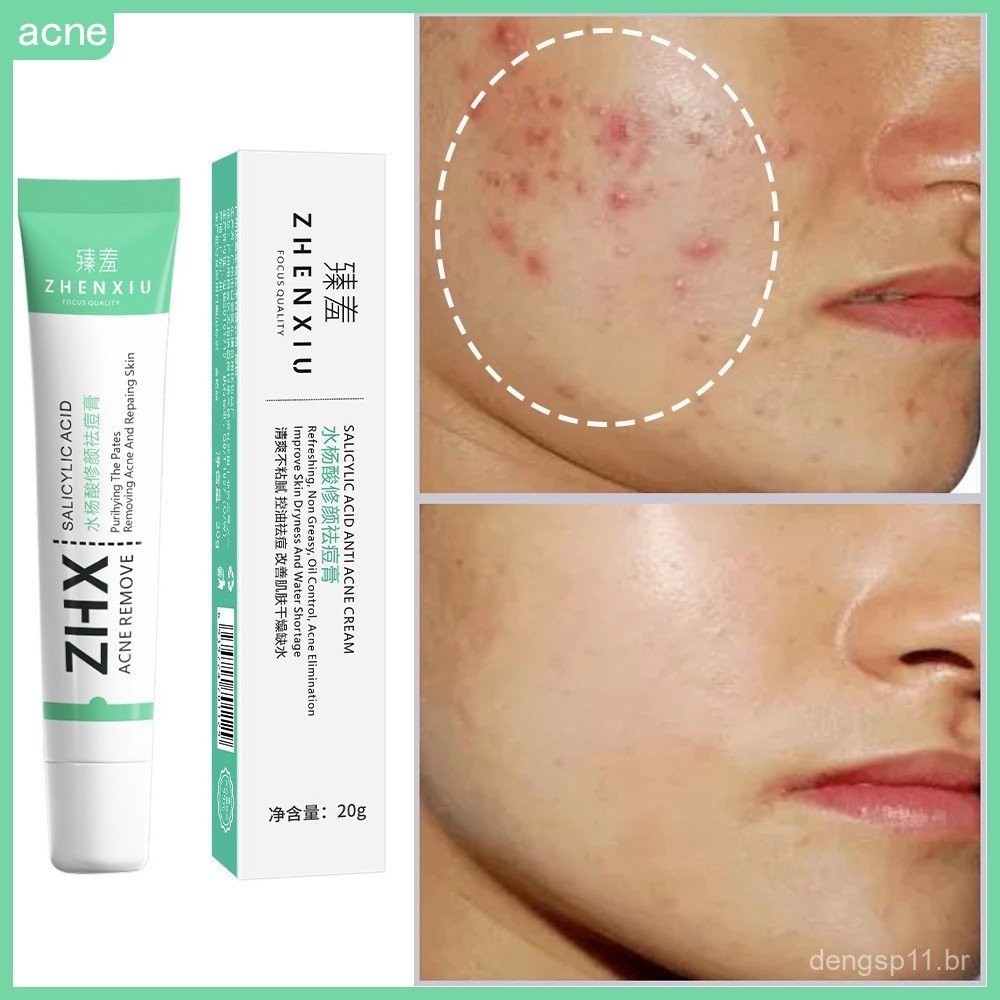 Creme Facial Anti-Acne com Ácido Salicílico para Remover Oleosidade e Cravos, Clareamento de Cicatrizes em Oferta na Shopee
