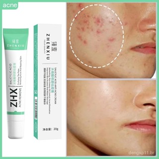 Creme Facial Anti-Acne com Ácido Salicílico para Remover Oleosidade e Cravos, Clareamento de Cicatrizes em Oferta na Shopee