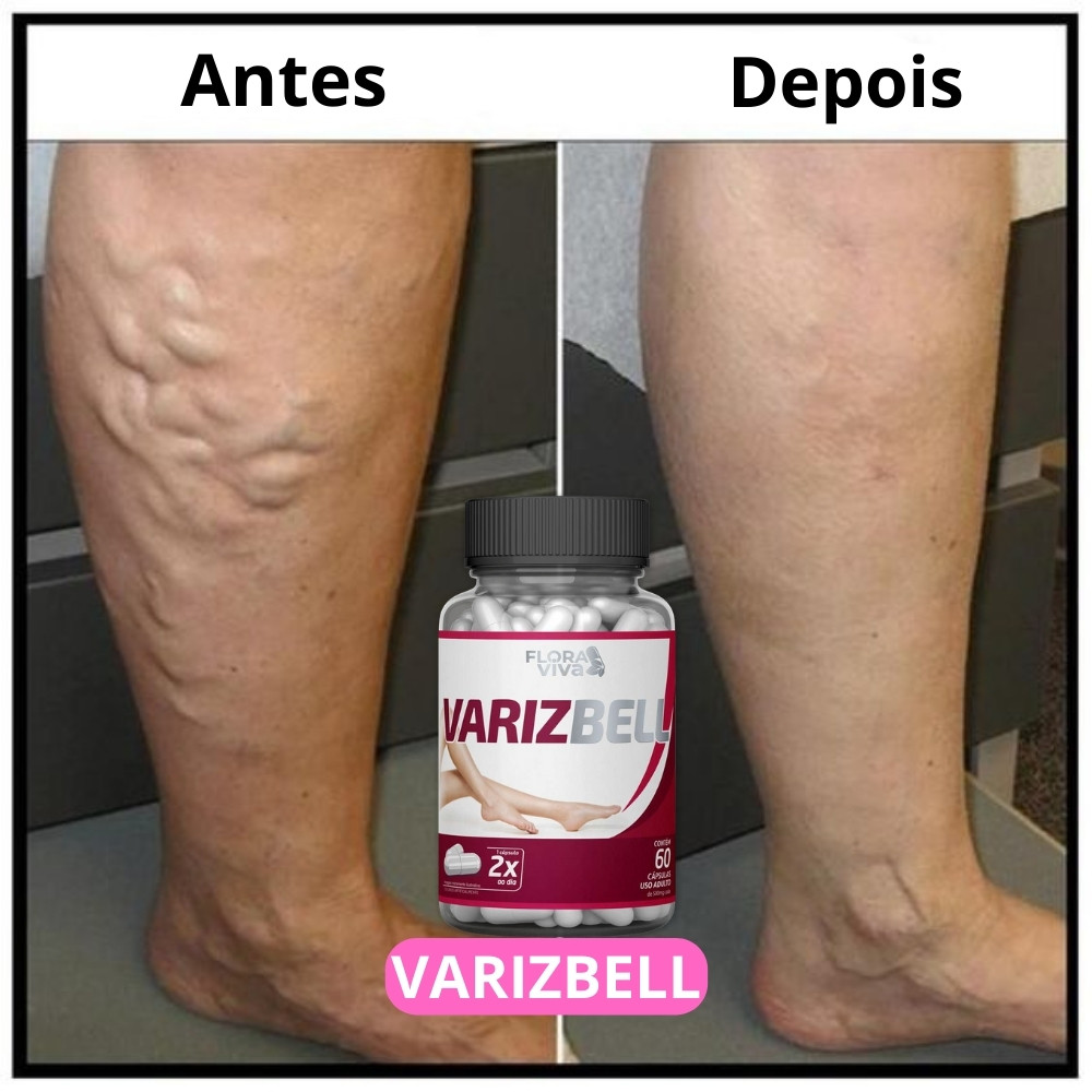 Varizbel Para remover Varizes, Dores e inchaços, Para um bem estar Vascular
