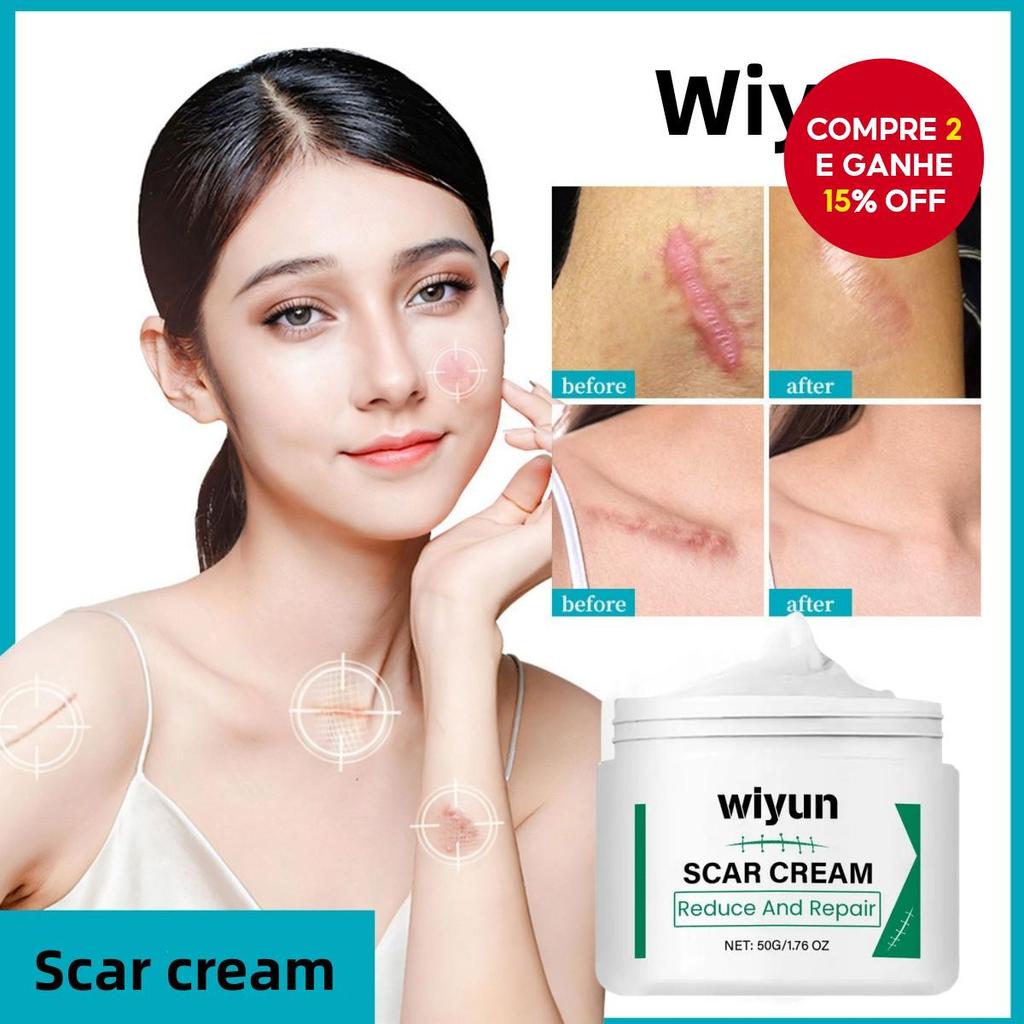 Creme Avançado para Remoção de Cicatrizes - Creme para Cicatrizes Cirúrgicas, Cicatrizes de Acne, Cicatrizes de Cezárea,