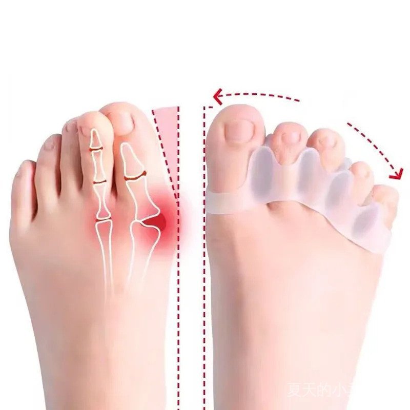 2 Peças Separador de Dedos de Silicone para Pés e Mãos, Corretor de Joanete Hallux Valgus, Alinhador de Dedos, Separador