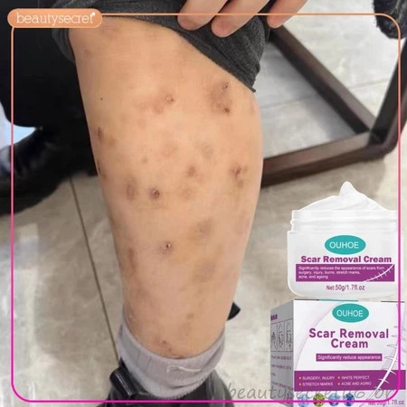 Creme Eliminar Cicatrizes Pretas Remover Feridas Antigas Picada de Mosquito Cicatriz Quelóide Queimaduras Scal -beleza