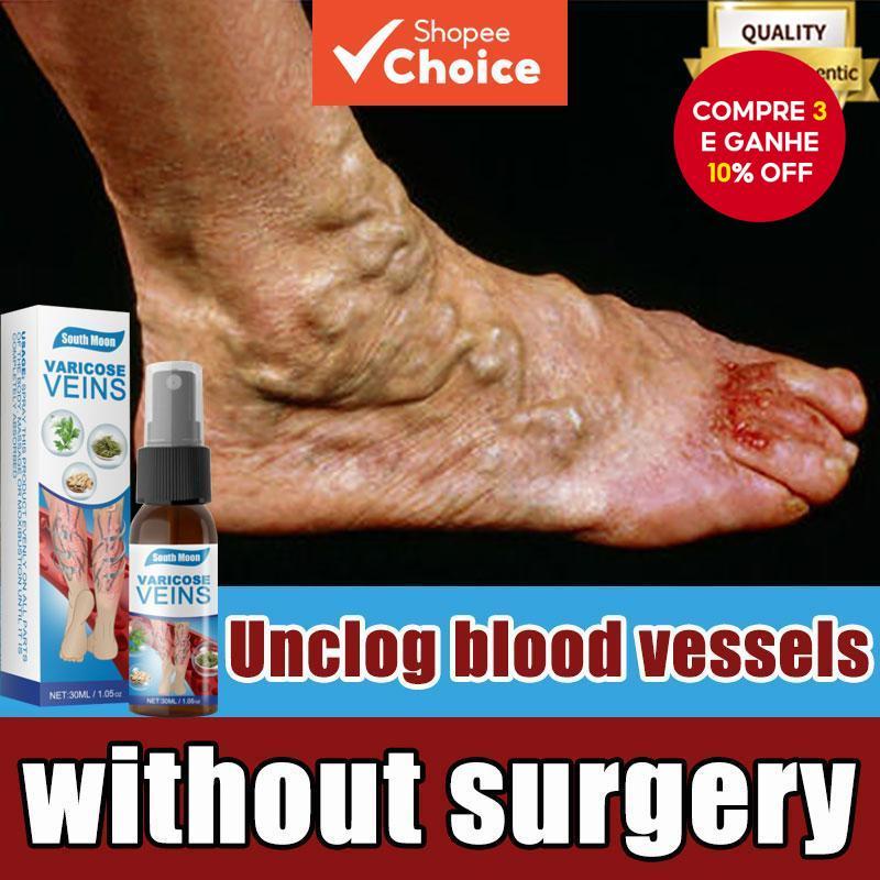SOUTH MOON Spray para Veias Varicosas 30ml Suaviza Vasos Sanguíneos Protuberantes com Apenas Uma Aplicação em Oferta na Shopee