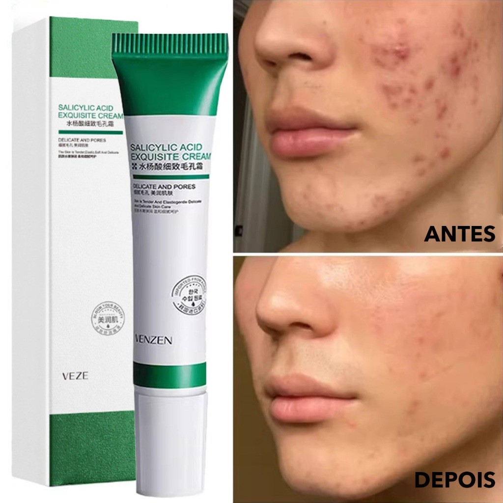 Creme de Ácido Salicílico para Redução de Poros - Loção Facial Hidratante Redução de Poros Dilatados em Oferta na Shopee