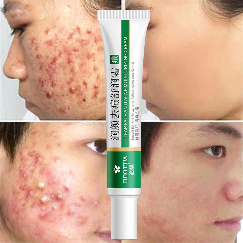 Creme Eficaz Para acne/Óleo De Controle/gel Cuidados Com A Pele 20g