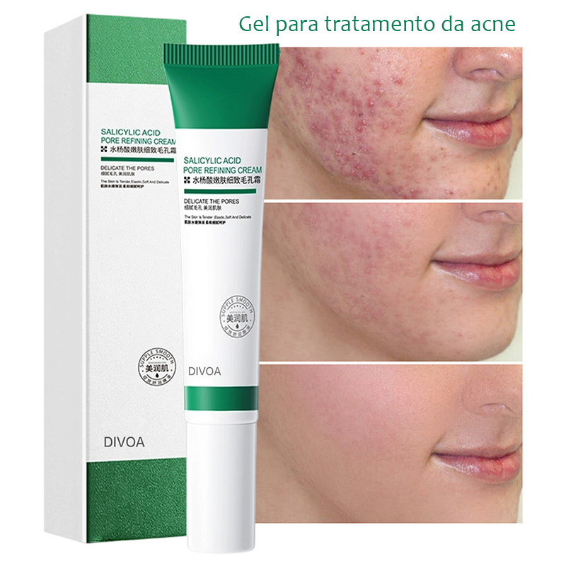 Creme De Ácido Salcyclic 20ml Para Remoção De Poros/Acne & Clareamento/Anti-Ássidade em Oferta na Shopee