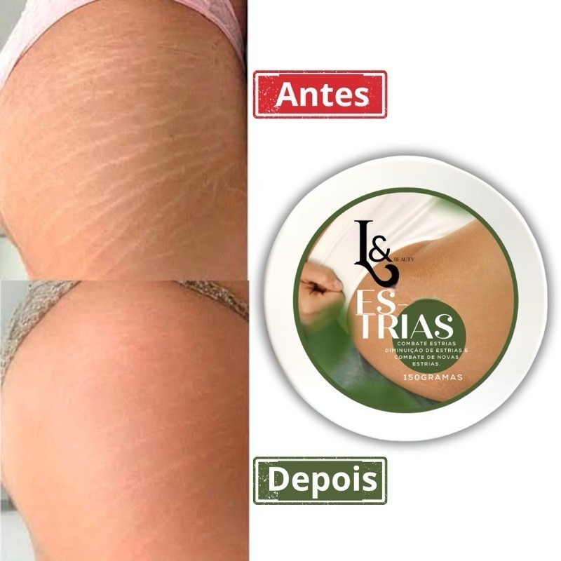 Creme Anti Estrias 150g - Trata e Previ Estrias, Fácil de Aplicar