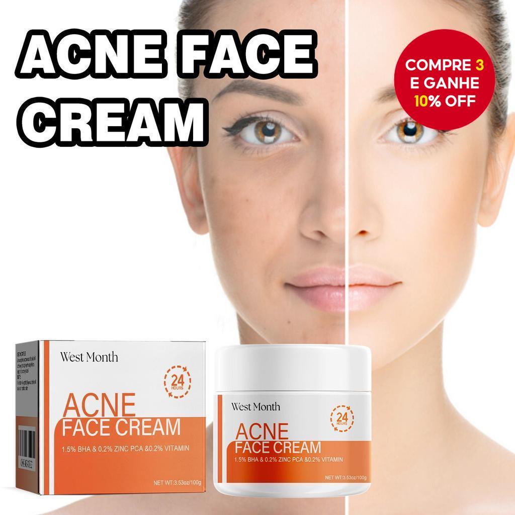 Creme Facial para Acne West&month com Ácido Salicílico - Tratamento para Acne Cística para Adolescentes e Adultos,