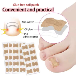 KIT 30/60/90 Adesivo para Unhas Encravadas E Unhas Dos Pés E Mãos Cobertura para Unhas Fácil Aplicação Sem Cola