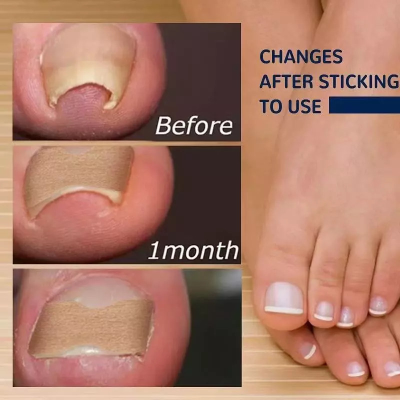 KIT 30/60/90 Adesivo para Unhas Encravadas E Unhas Dos Pés E Mãos Cobertura para Unhas Fácil Aplicação Sem Cola