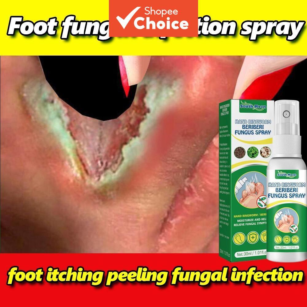  Tratamento eficaz para frieiras com nosso spray desodorante para os pés - 30ml 【Escolha】