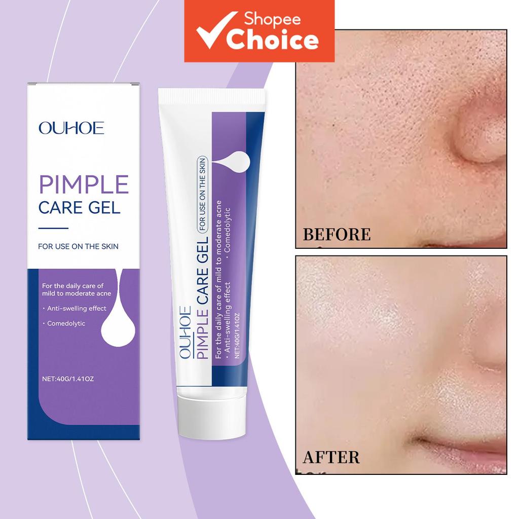 Gel De Remoção De Acne Reduzir Cravo Desbotamento Manchas Encolher Poros Calma Vermelhidão Suave Calmante Hidratante Rep