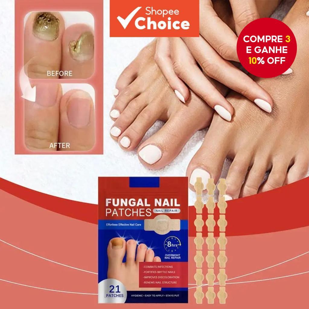 NOVO 21Pçs Adesivo para Fungo de Unha Impermeável Reparador de Unha Adesivo de Correção p...
