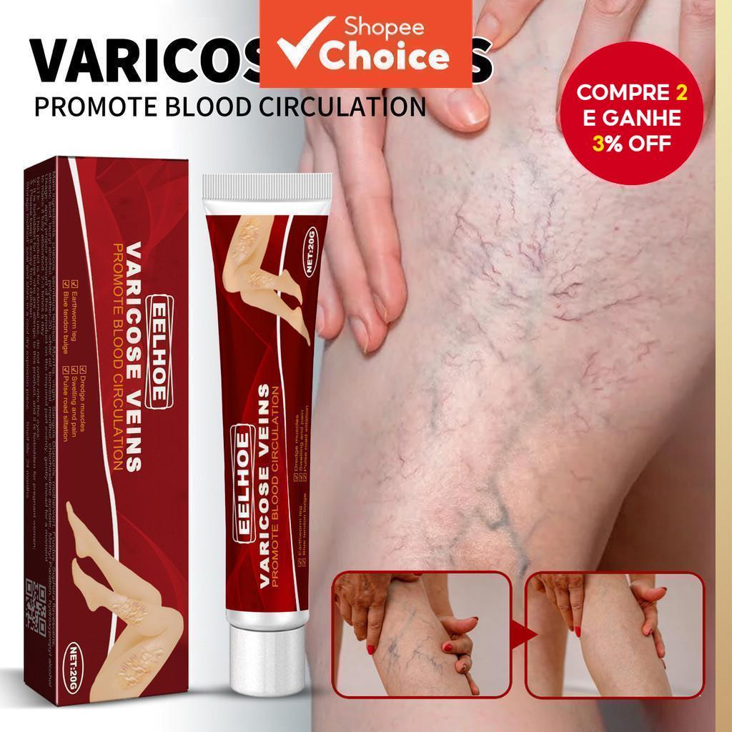 Creme Removedor de Varizes Eelhoe - Eficaz para Cuidados com as Veias das Pernas, Original Earthworm 【Escolha】