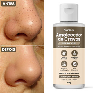 Sérum Amolecedor de Cravos YouShine 100g Remoção Fácil Cicatrizante Antisséptico em Oferta na Shopee