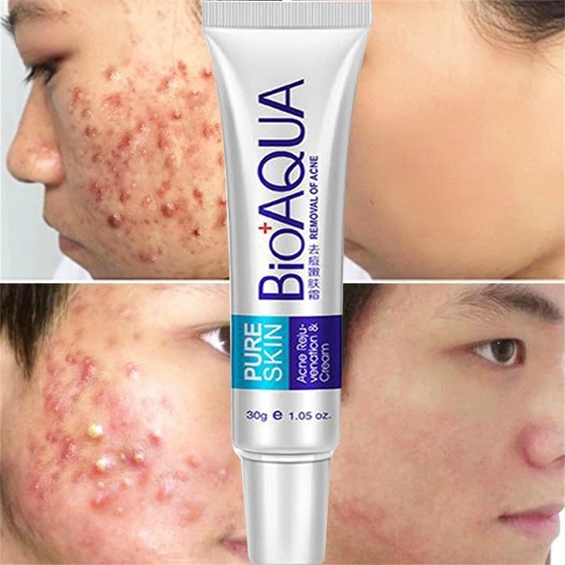 Creme para remoção de cicatrizes de acne/tratamento Anti-acne/clareamento/controle de óleo/cravos de poros — imagem 1
