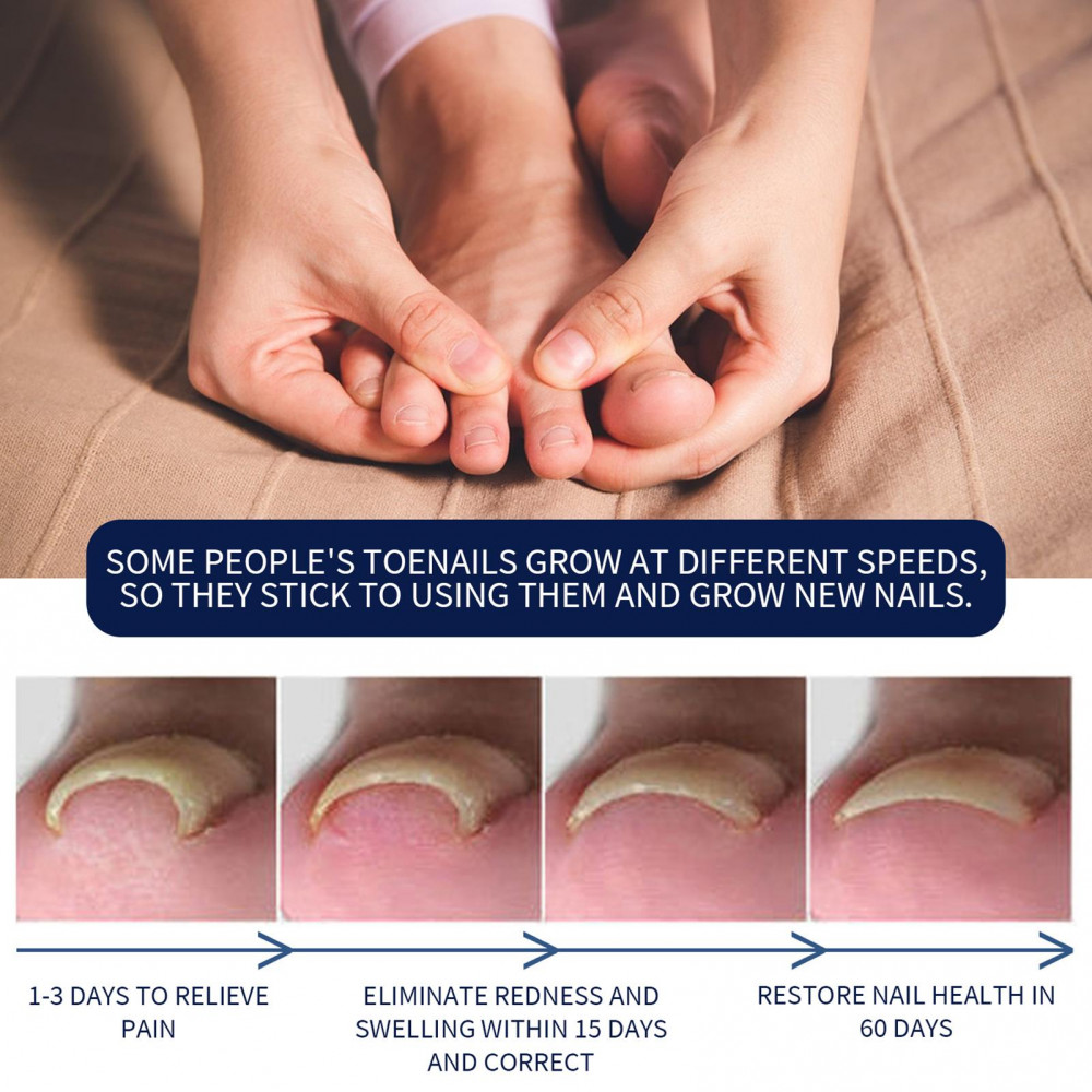 Óleo De Correção De Unhas Encravadas 10ml-Fórmula Natural Para Alívio De Desconforto E Suavização , Suporta Crescimento