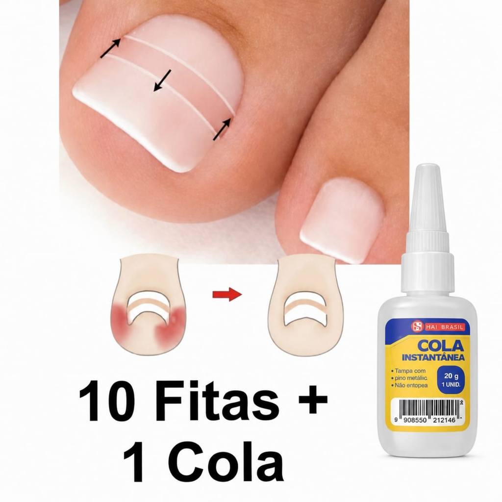 Fita Ortese Para Unha Encravada Desencravador Corretora 10 Pçs + Cola