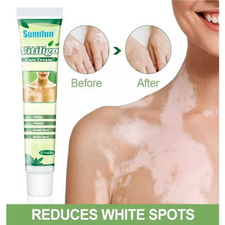 Creme de Tratamento Sumifun White Label Reduz Manchas Brancas na Pele e Cuidado com Vitiligo 8MJG