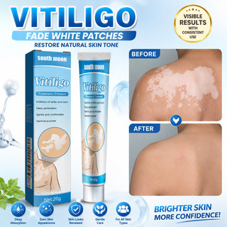 TUOP Advanced (1 Unidade/2 Unidades/3) Pomada para a Pele com Manchas Brancas South Moon 20g - Apoio para Vitiligo, Cuid