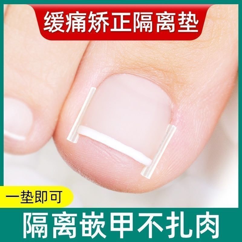 Paroníquia correção de unhas encravadas Manicure dedicado isolamento junta correção unhas encravadas não amarrar carne l