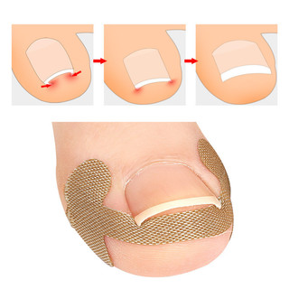 Corretor de unhas remendo de correção de dedo do pé remendo de unha evitar carne encravada rolo de unhas remendo de unha