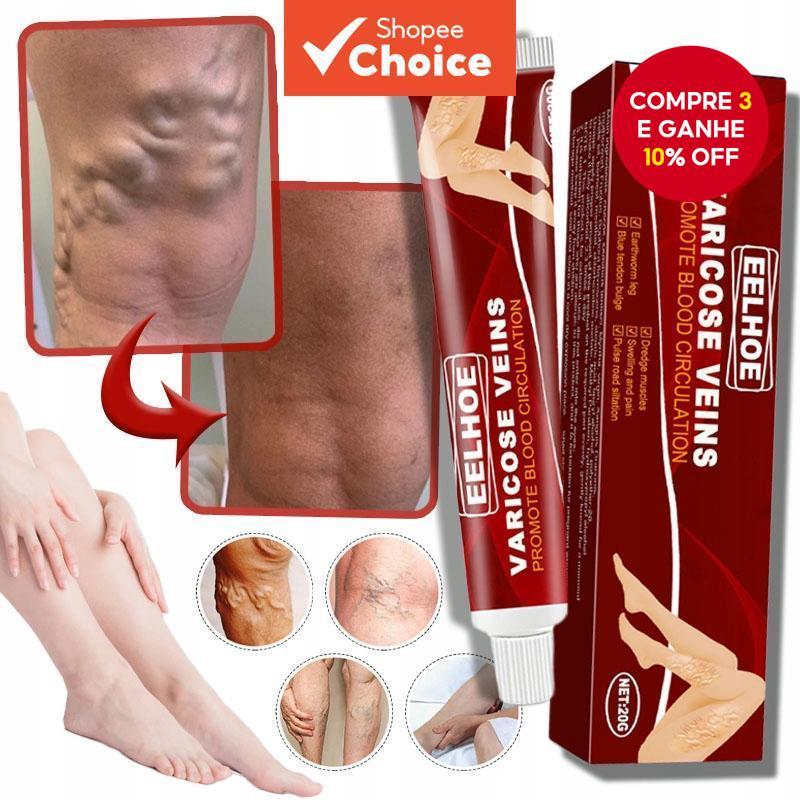  Creme para Varizes, Pomada de Massagem Venosa, Creme para Inflamação de Pernas, Vasculite, Flebite, Pernas de Aranha,