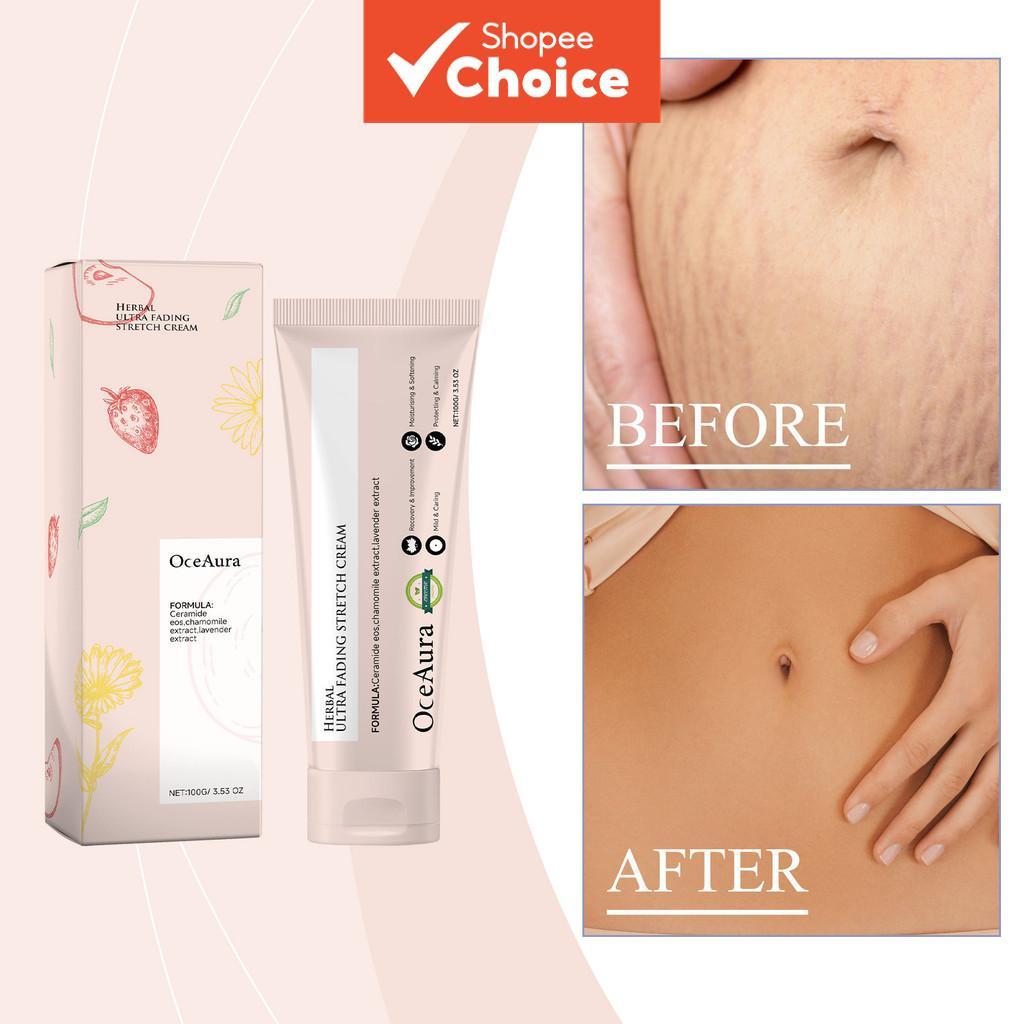  Creme para Estrias Nutritivo 100g – OCEAURA para Pós-Parto e Cuidados com Cicatrizes, Melhora da Textura e Tom da Pele,