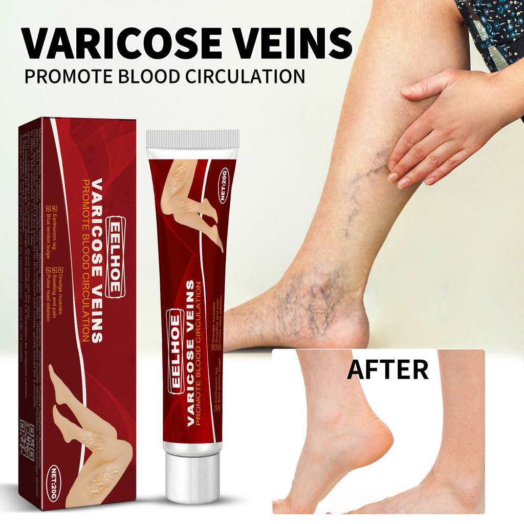 Novo creme para veias varicosas de 20g com Gerânio, Lentilha e Erva-de-São-Cristóvão | Previne a reincidência | Fórmula