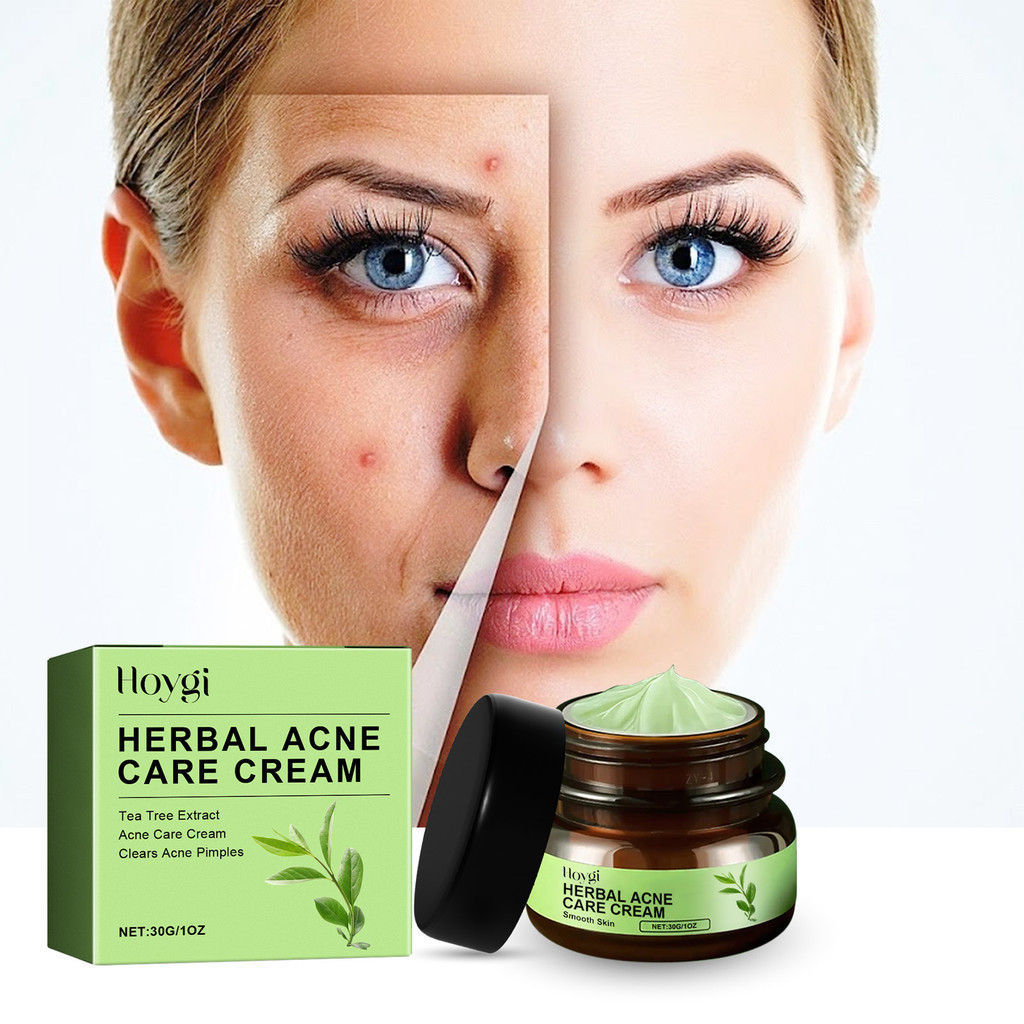 Creme de Remoção de Acne Herbal Reduzir a Acne Pele Acne Fechada Limpeza Facial Hidratante Suavizante