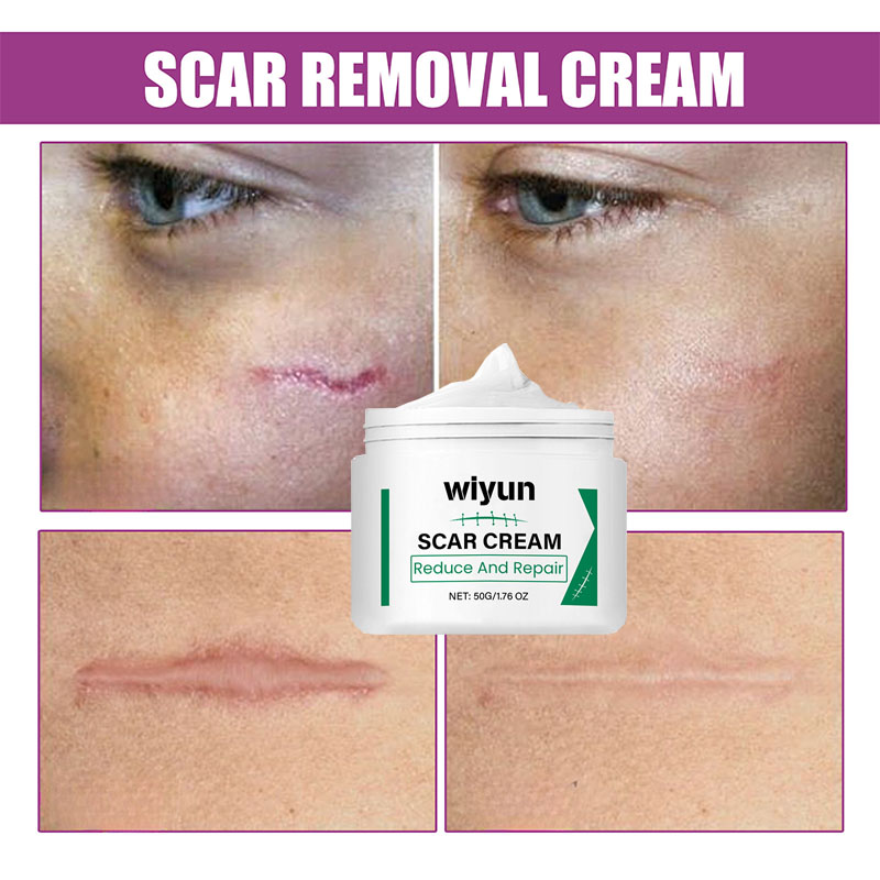 Creme Para Remoção De Cicatrizes 50g , Avançado Cirúrgicas , De Acne , Seção C , Queimadur...