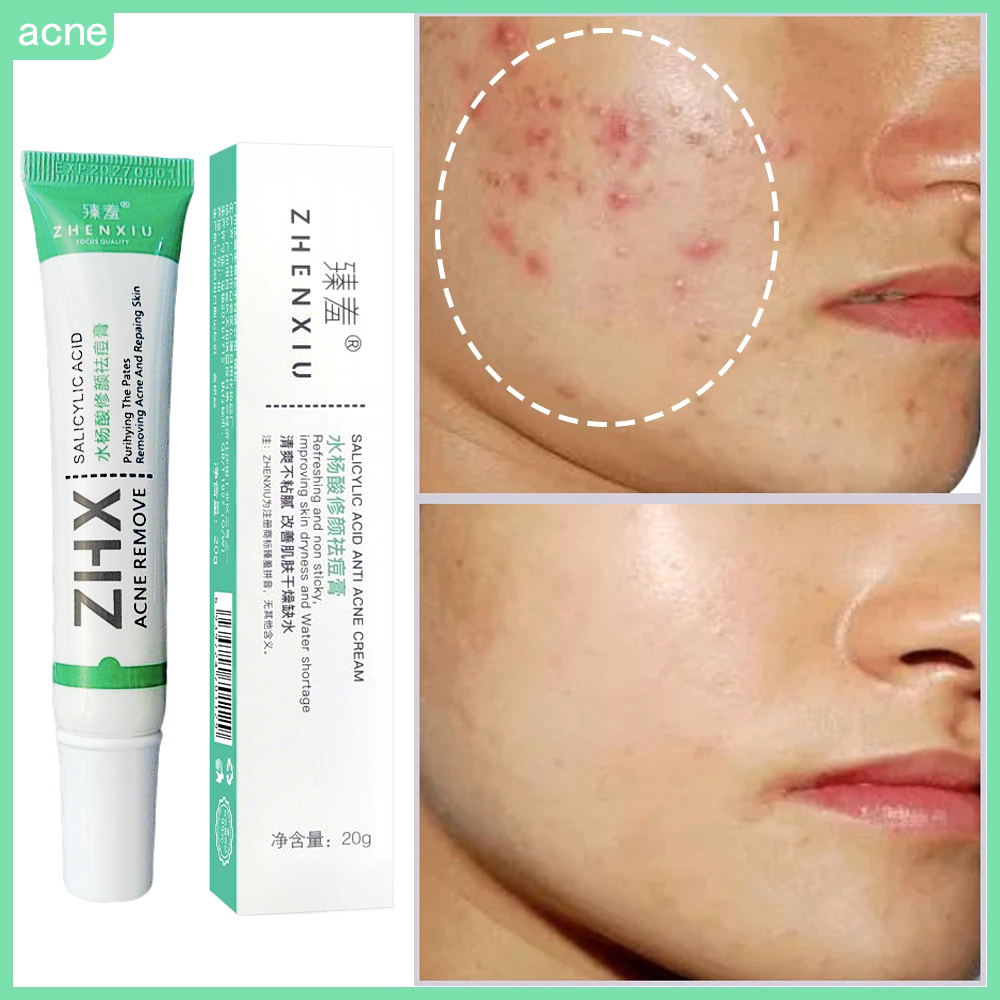 Creme Clareador Espinhas: Onde Comprar | BuscaProdutos