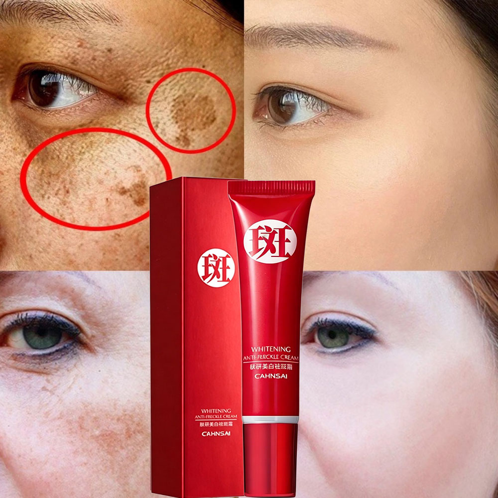 Creme Clareador de Manchas Melasma - Removedor de Sardas, Reduz Manchas de Acne, Ilumina e Uniformiza o Tom da Pele