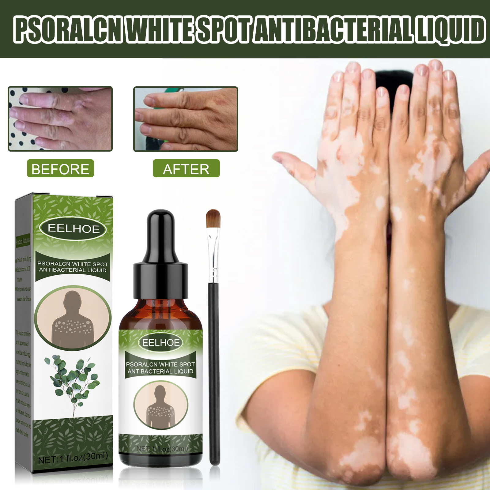 Creme para vitiligo, creme para pigmentação, essência para vitiligo, usado para remover manchas brancas no rosto.